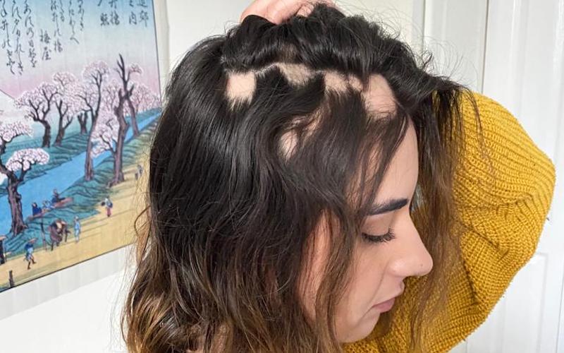 Clapham Resident 'Losing her Womanhood' after Long Covid Hair Loss Clapham Resident 'Losing her Womanhood' after Long Covid Hair Loss