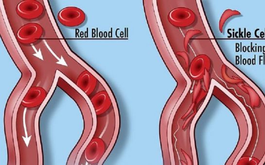 A Diagram Showing Cell differences in sickle cell