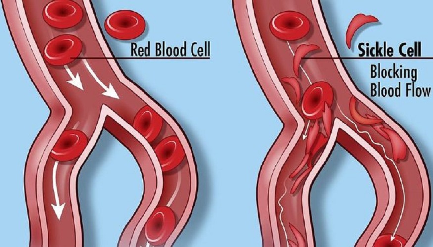 A Diagram Showing Cell differences in sickle cell